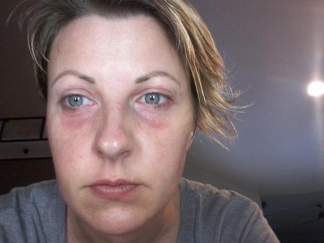 My Itchy Journey: Overcoming 10 Years of Misdiagnosed Skin Allergies